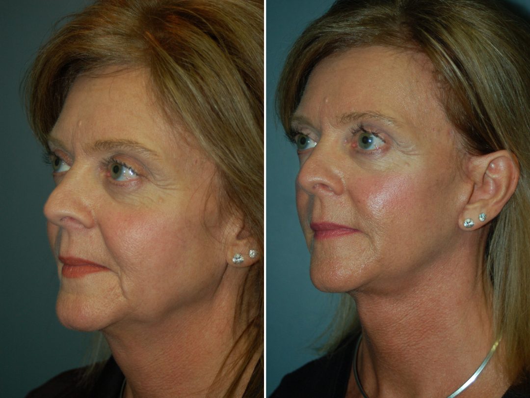 Facelift & Neck Lift_1