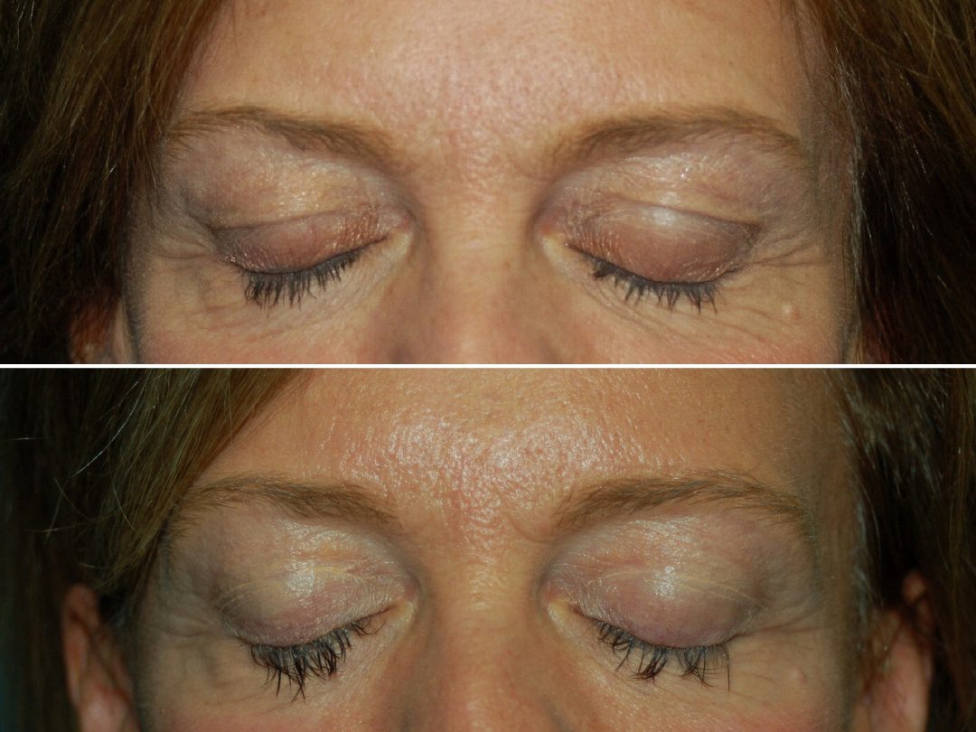 Blepharoplasty 1_Up