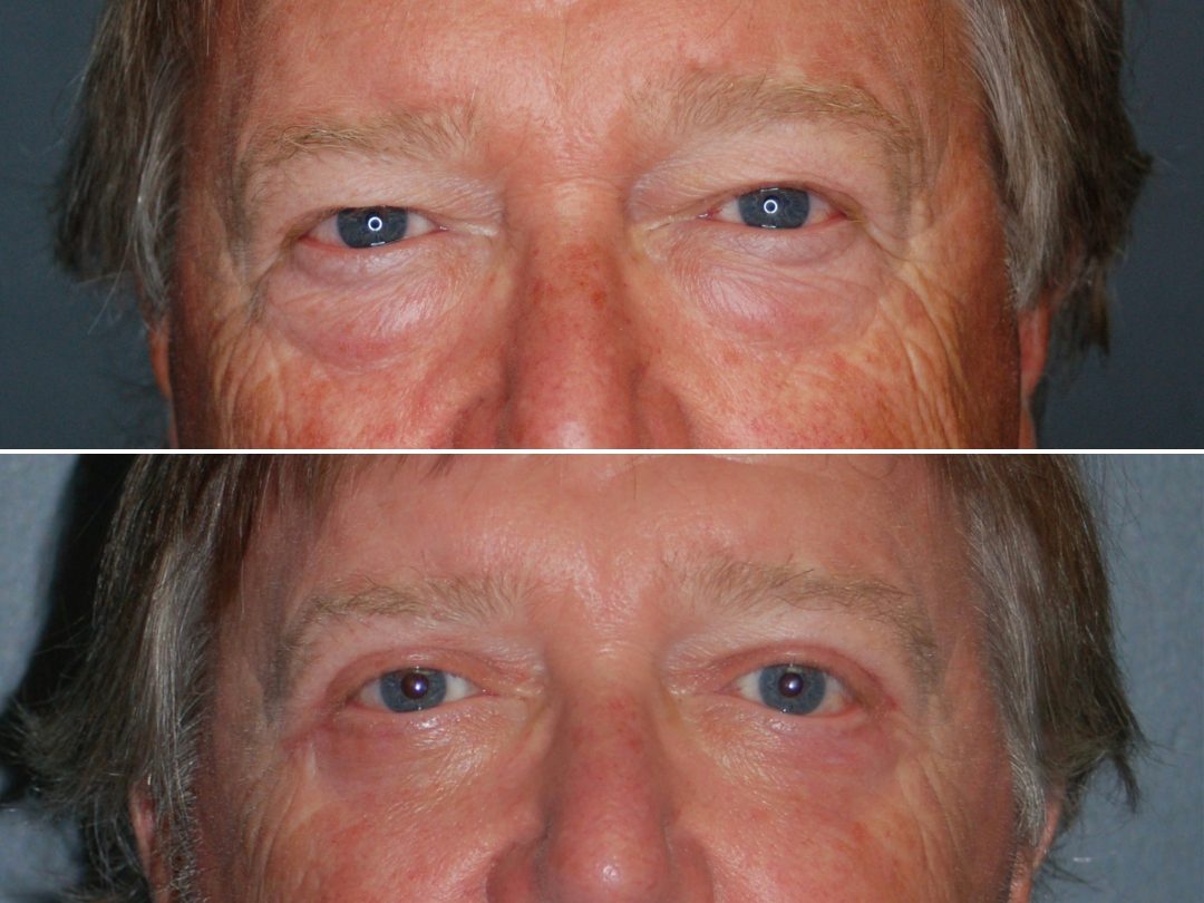 Blepharoplasty 2_Up & Low Transcutaneous