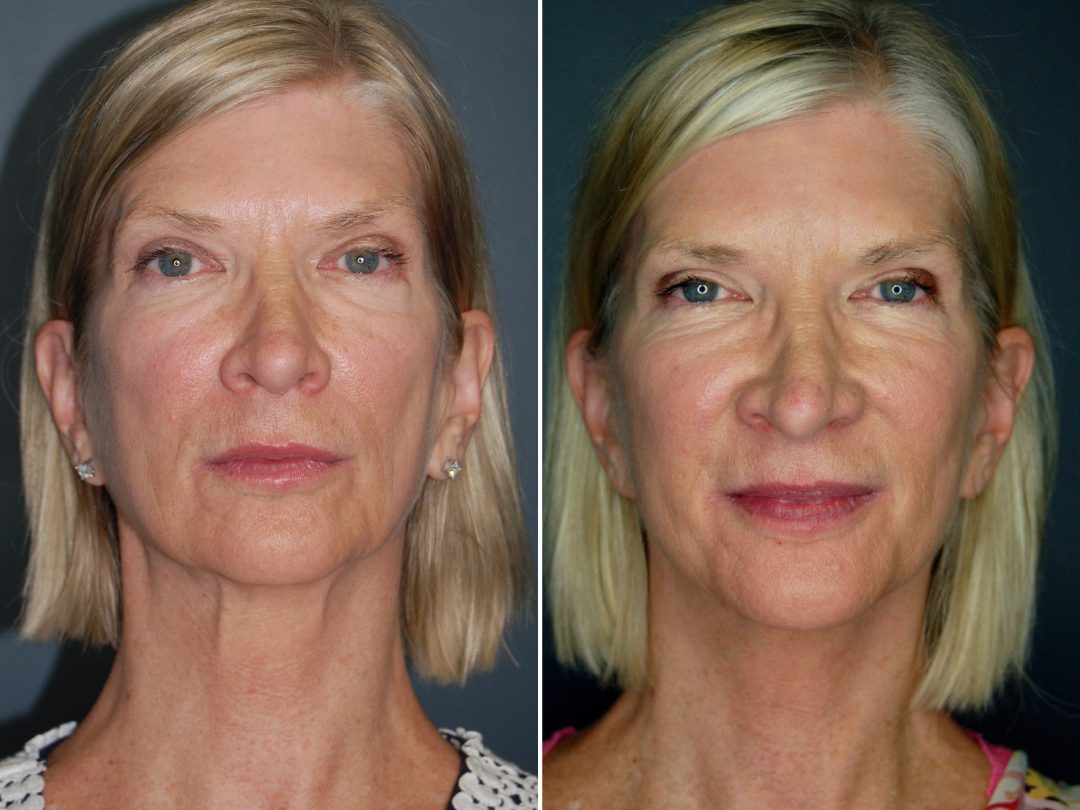 Facelift & Neck Lift_2_Platysmaplasty