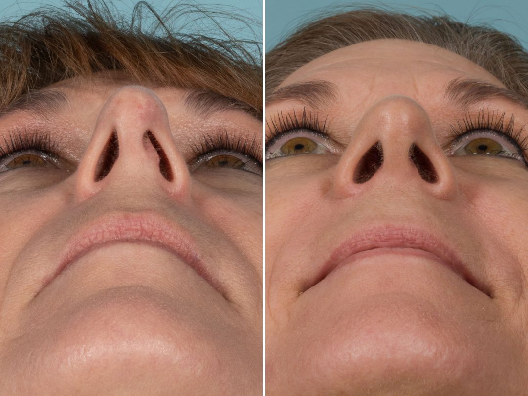 Closed Rhinoplasty - Photo Gallery - Scottsdale, AZ