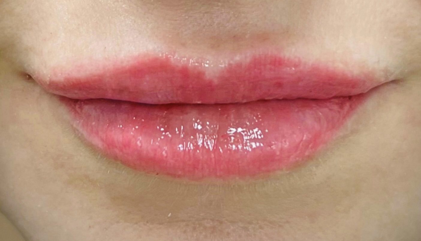 Filler Lip Augmentation_1