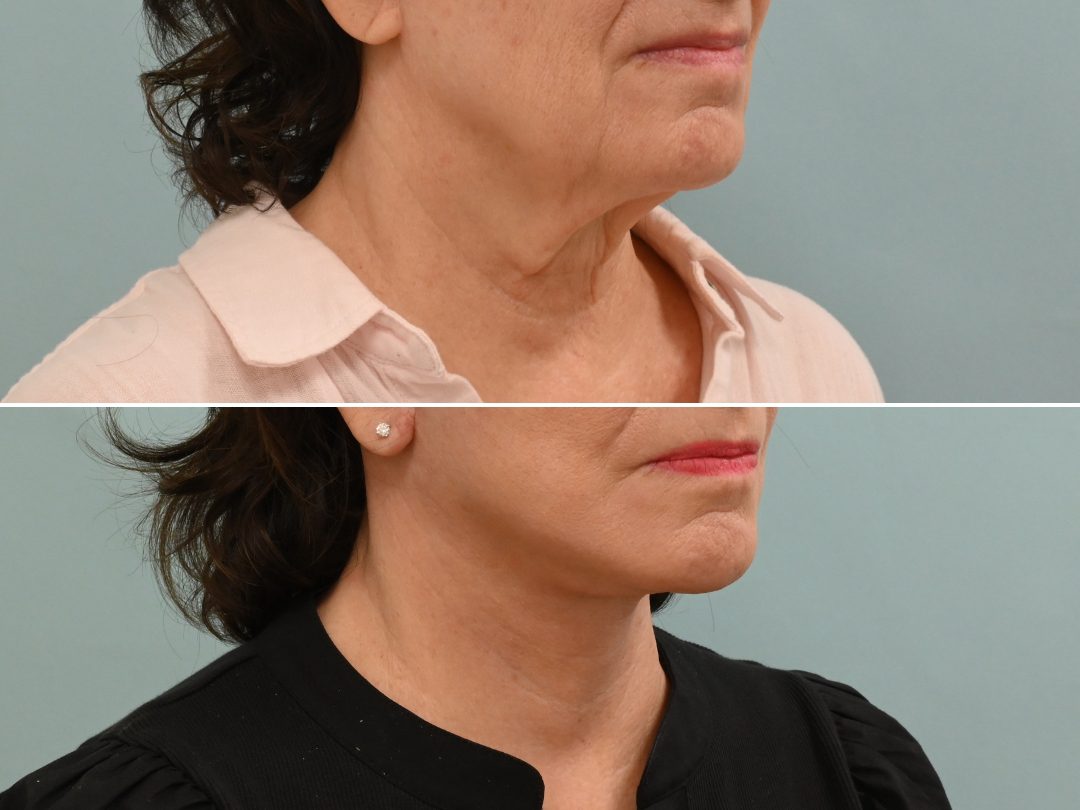 Facelift & Neck Lift_3_Platysmaplasty