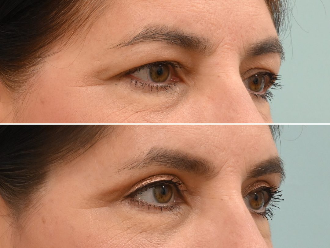 Blepharoplasty 3_Up