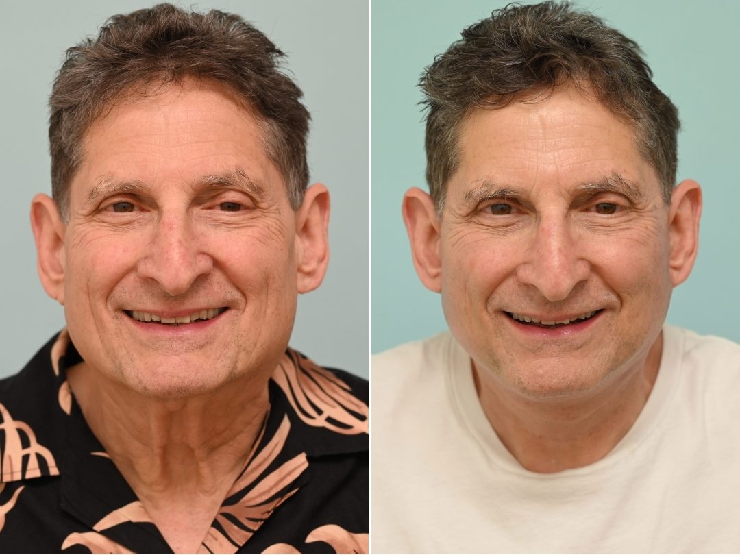 Facelift & Neck Lift Male_3_Platysmaplasty