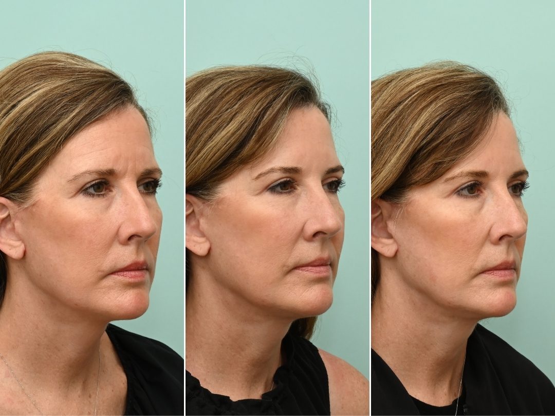 Facial Plastic Surgery Recovery_1