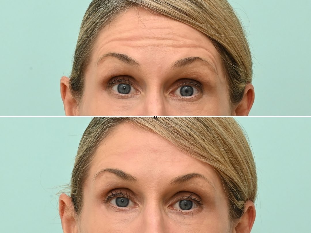 Botulinum Toxin Forehead & Glabella_1