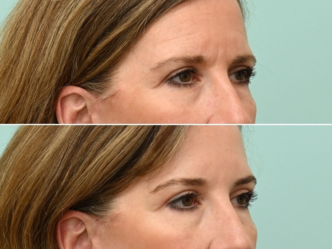 Botulinum Toxin Chemical Brow Lift_1